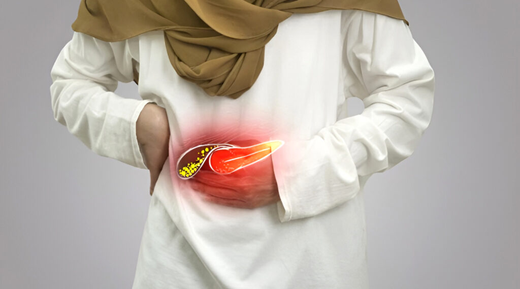 expert care for acute calculous cholecystitis