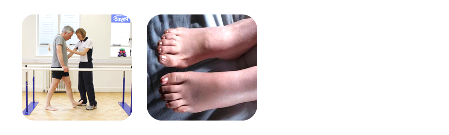 osteoarthritis and cartilage wear