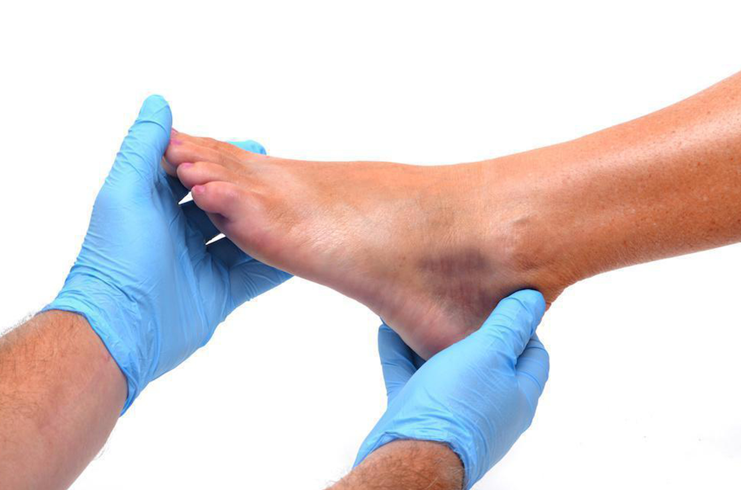twisted ankle or fracture