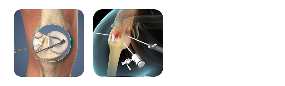 arthroscopy
