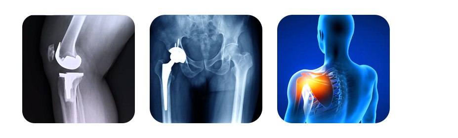 joint replacement surgery