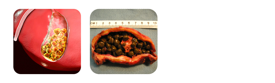 types of gall stones
