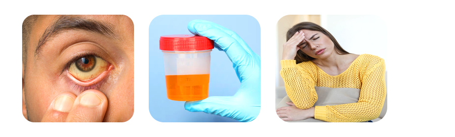 symptoms of high bilirubin levels