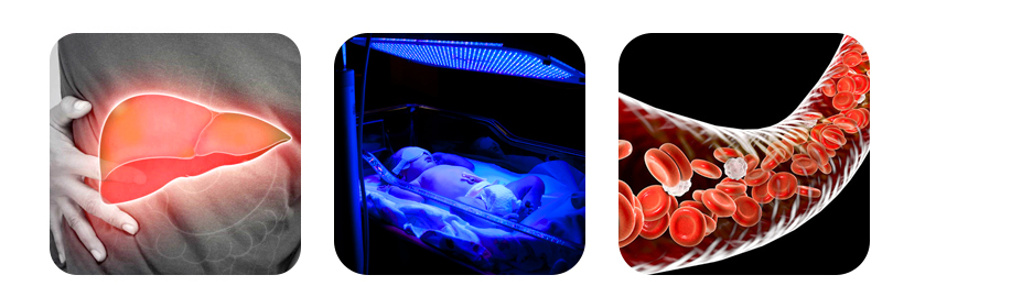 treatment for high bilirubin levels