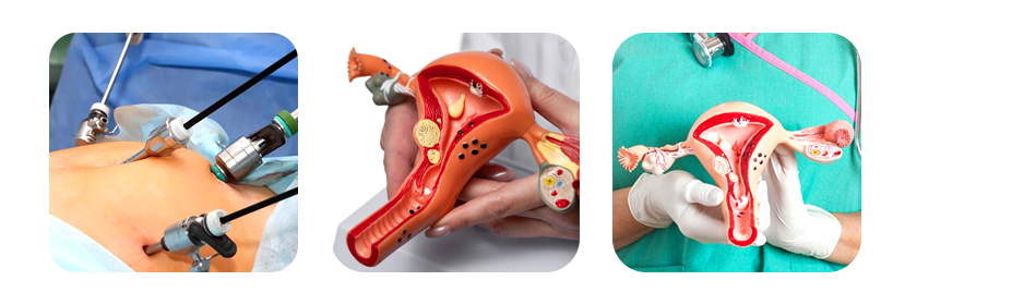 laparoscopic gynecology surgery