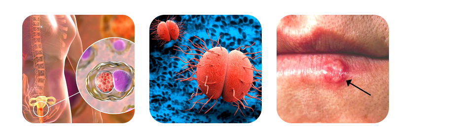 sexually transmitted infections